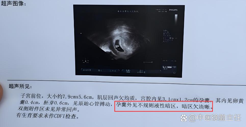 怀孕初期孕囊看不到只有小暗区图标