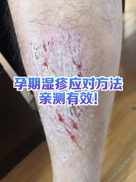 湿疹根治方法有哪些缩略图