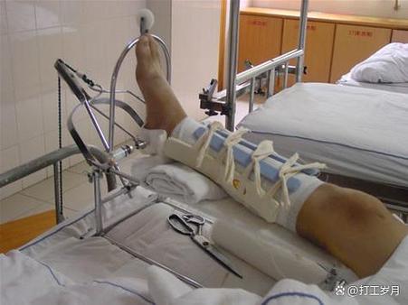 腓骨取钢板几天能脱拐缩略图