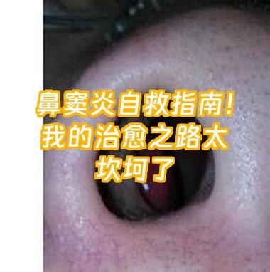 鼻窦炎吃什么药最好根治最快最有效缩略图