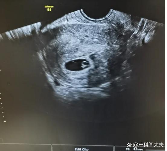 怀孕6周没胎心能看见胎囊吗图标