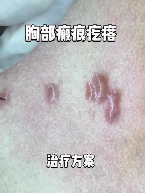 胸口长疤痕疙瘩是什么病
