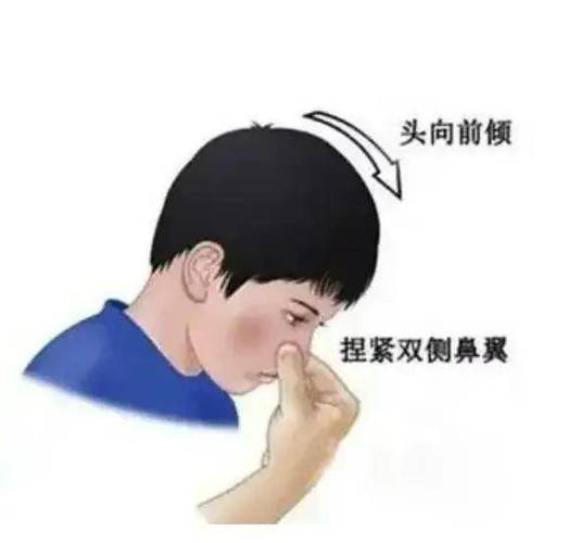 止鼻血绑哪个手指缩略图