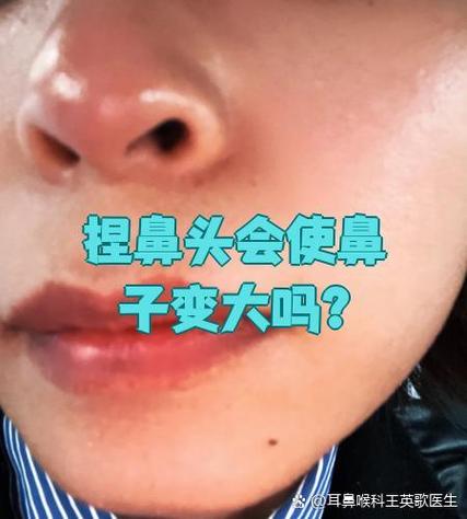 捏鼻子会导致鼻翼变大吗