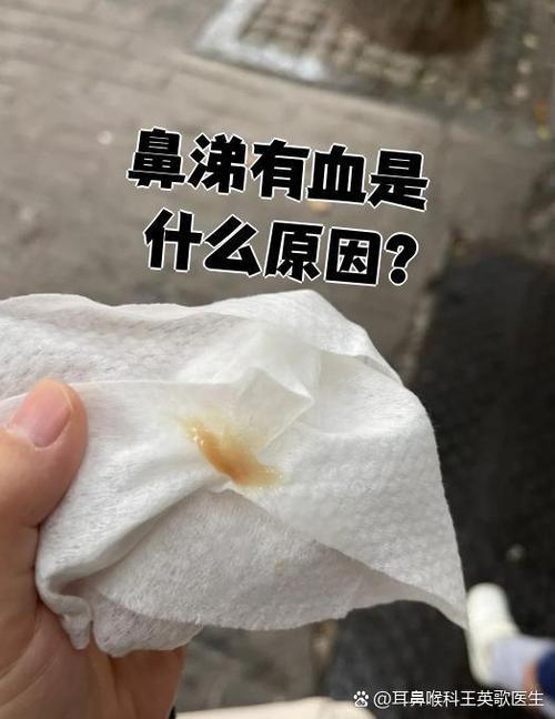 感冒擤鼻涕有血丝但不流鼻血图标