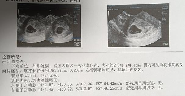 B超从暗区到孕囊有多久图标