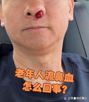 老年人突然流鼻血是什么原因图标