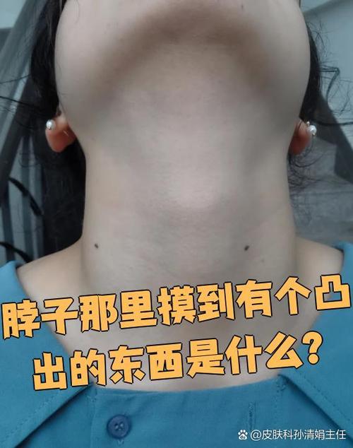 咽喉结节吃什么药可以散结