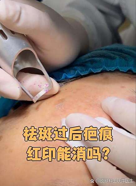 祛斑留下的疤痕怎样才能去掉缩略图