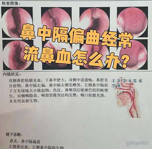 经常流鼻血是什么情况