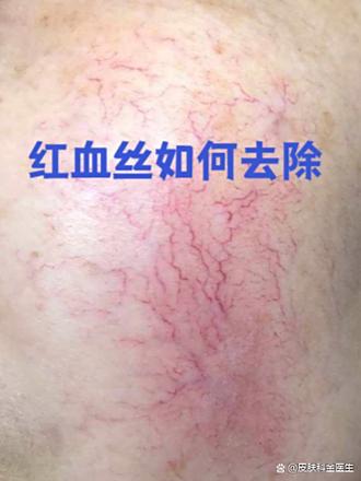 脸上红血丝怎么去除最快方法