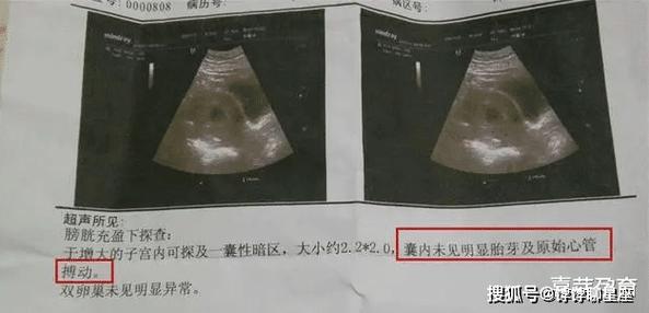 b超看不到孕囊,hcg显示怀孕图标