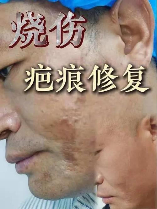 去腿上的疤痕最有效方法