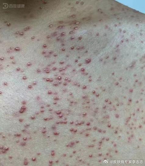 百度识别皮肤病扫一扫缩略图
