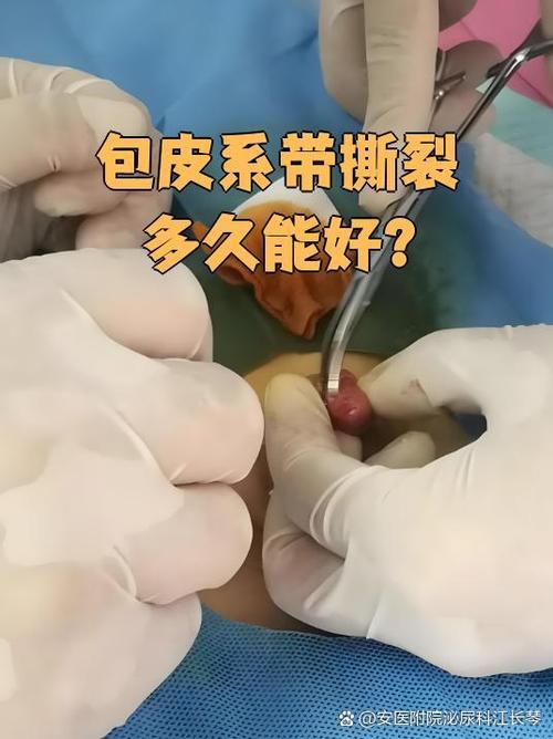 男性系带断裂能自己愈合吗图标