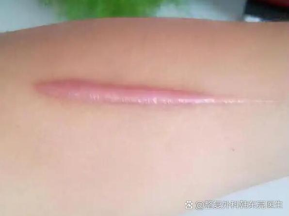 脸上有疤痕怎么消除最快最有效