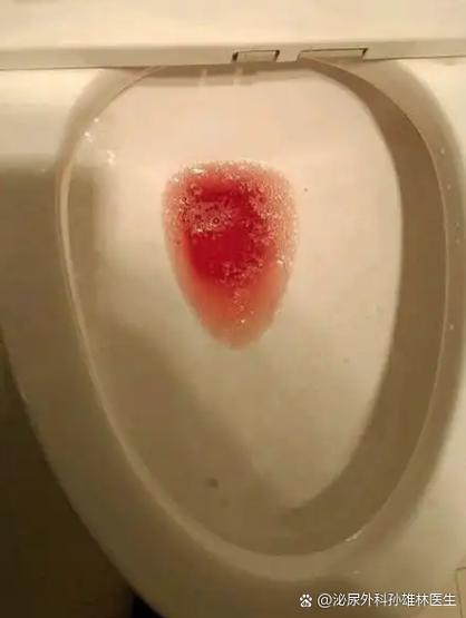 女性憋尿后尿血尿痛图标