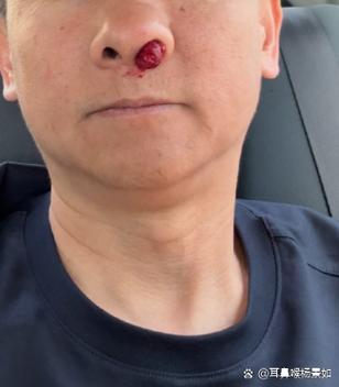 鼻子流鼻血是什么原因