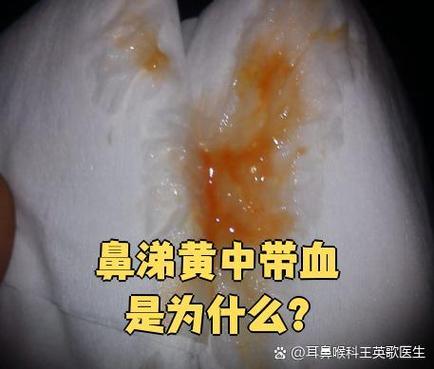 感冒了鼻涕很黄很浓还有血图标