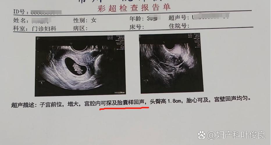 怀孕多少天可以看到孕囊