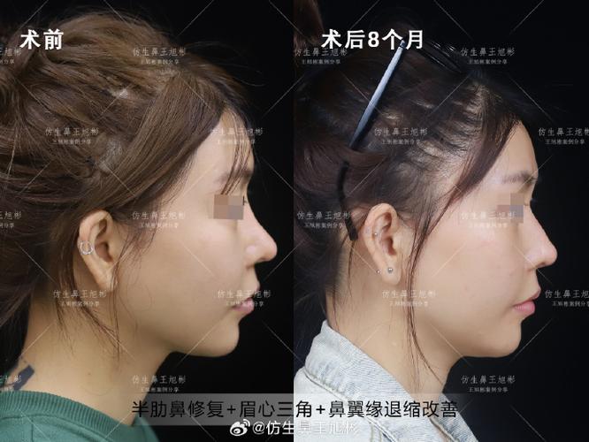 做完鼻子鼻头太尖能改吗