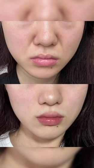 美容仪用了10天脸垮了