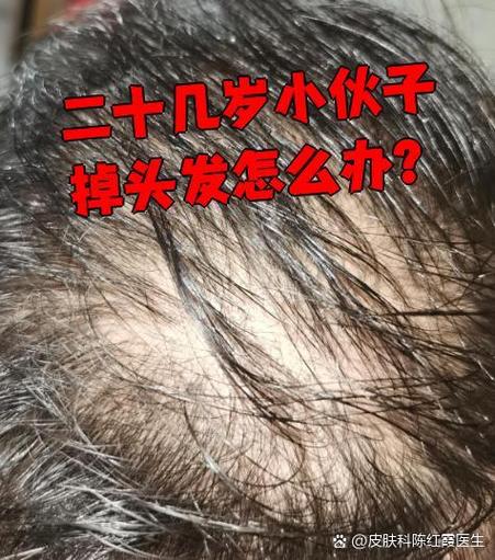 二十几岁小伙子掉头发怎么办图标
