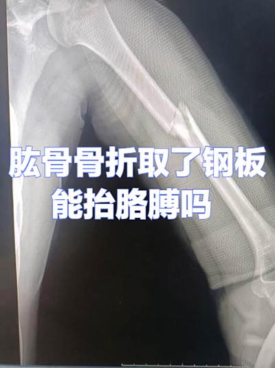 肱骨钢板不取的害处游戏截图