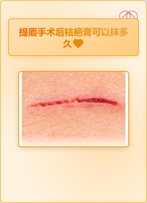 祛疤的最佳方法缩略图