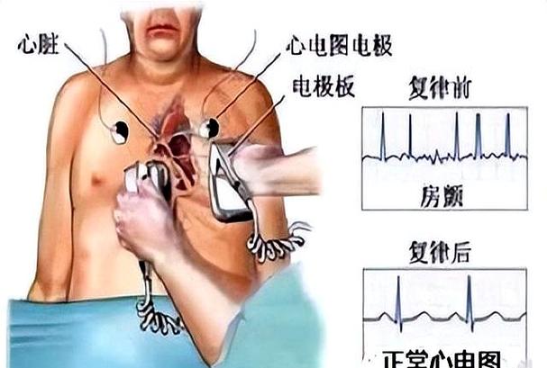 人一旦电复律就意味着什么缩略图