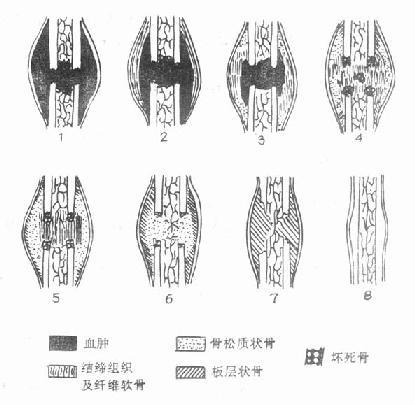 骨折会自己愈合吗图标