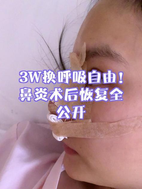 鼻窦炎怎么治疗彻底除根效果最好