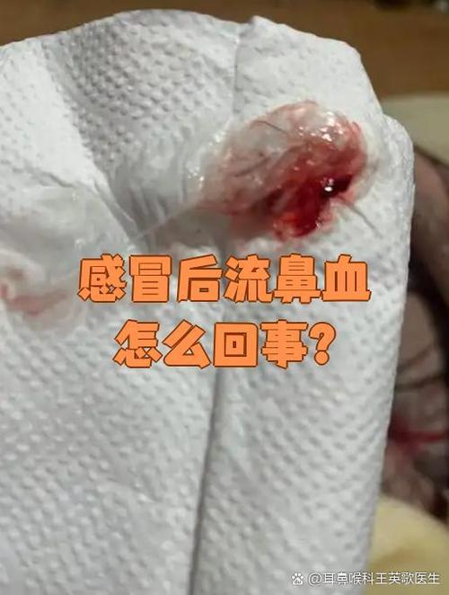 感冒了流黄鼻涕还带血