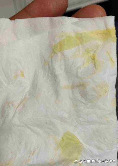 鼻子流黄水像滴水一样 原因