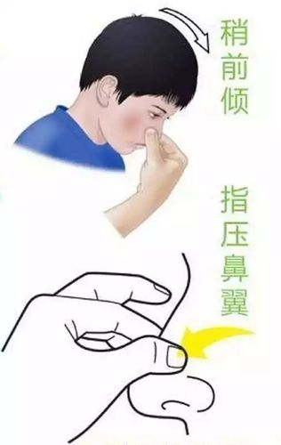 小孩流鼻血怎么止住