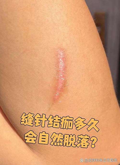 缝针疤痕祛除最佳时间