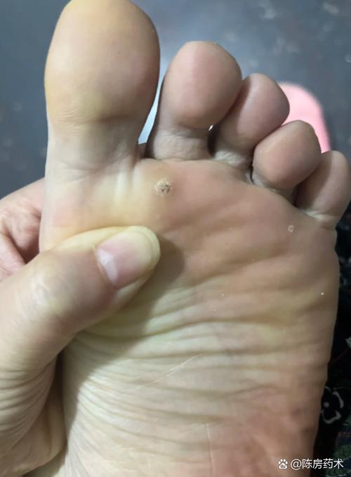 脚板病毒疣好治吗