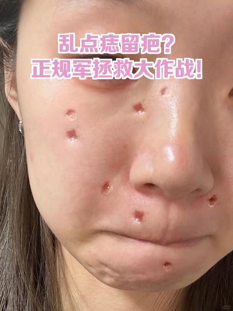 祛痣不留疤痕最有效方法缩略图