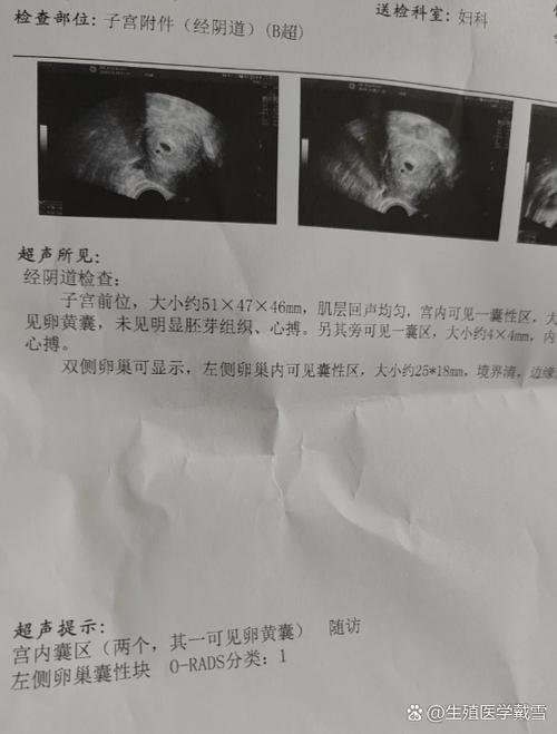 孕六周只看到囊性暗区图标