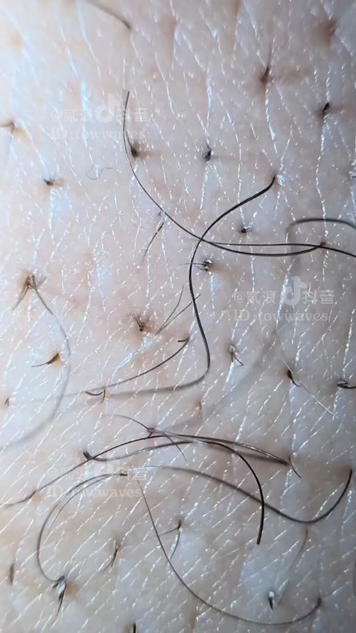 一个毛孔两根毛怎么办缩略图