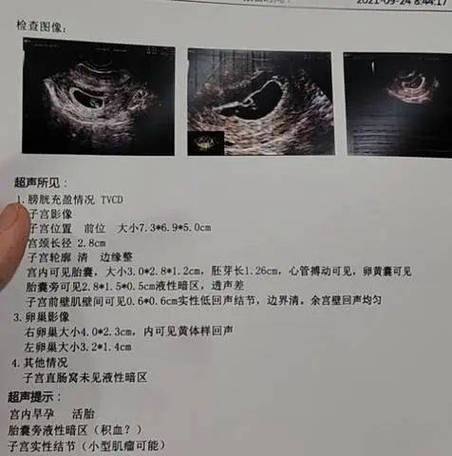 小囊样暗区可以判断怀孕多久么图标