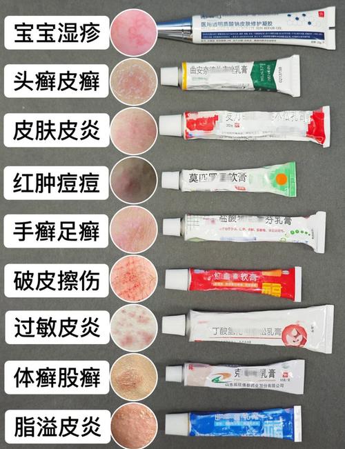 治疗湿疹的药膏哪一种效果好