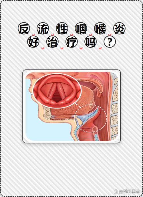 慢性咽喉炎怎么治疗能除根