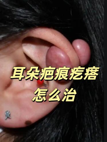 疤痕疙瘩有必要治吗