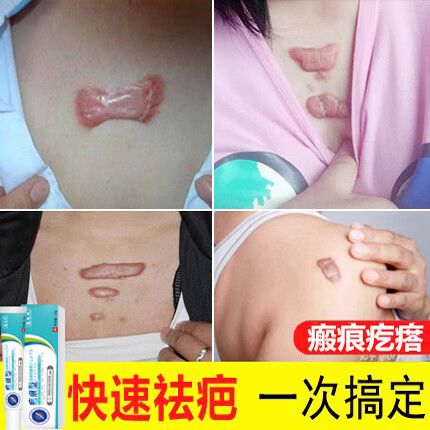 增生疤痕疙瘩最好的药膏