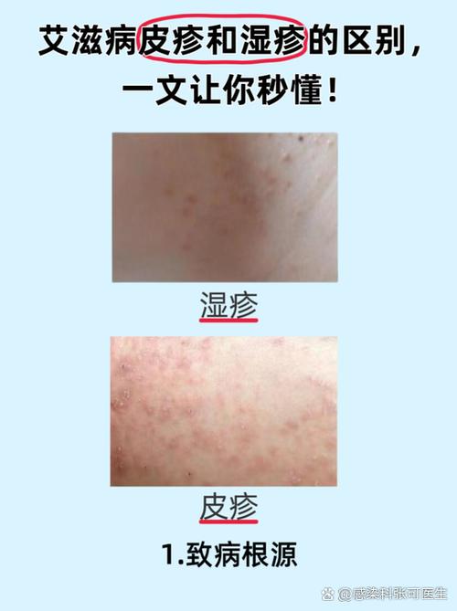 湿疹的正确治疗方法