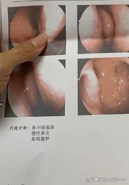怎么突然流鼻血是什么原因缩略图