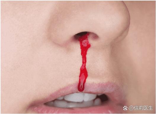 女性突然流鼻血要警惕
